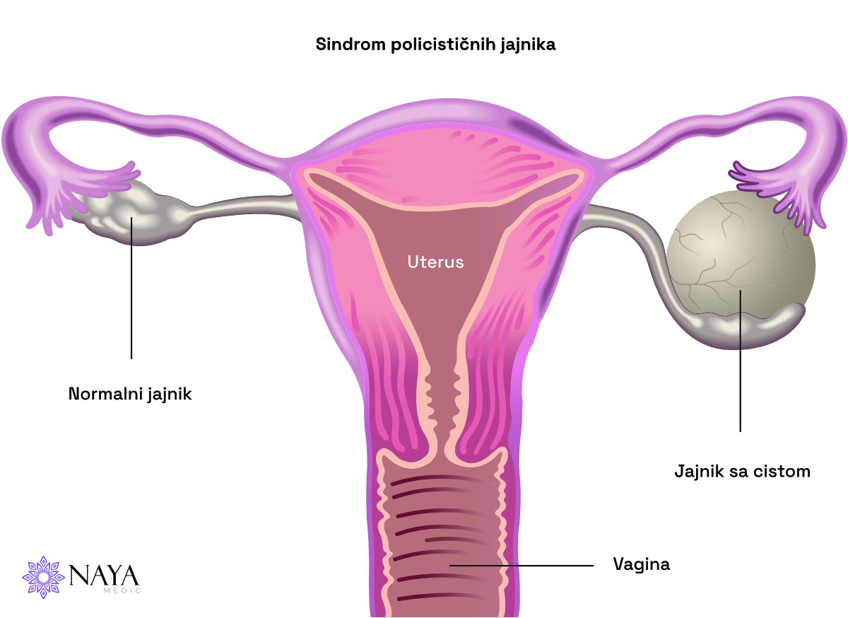 Policistični jajnici